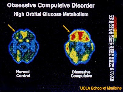 A comparison of brain scans between a normal person and an OCD patient.