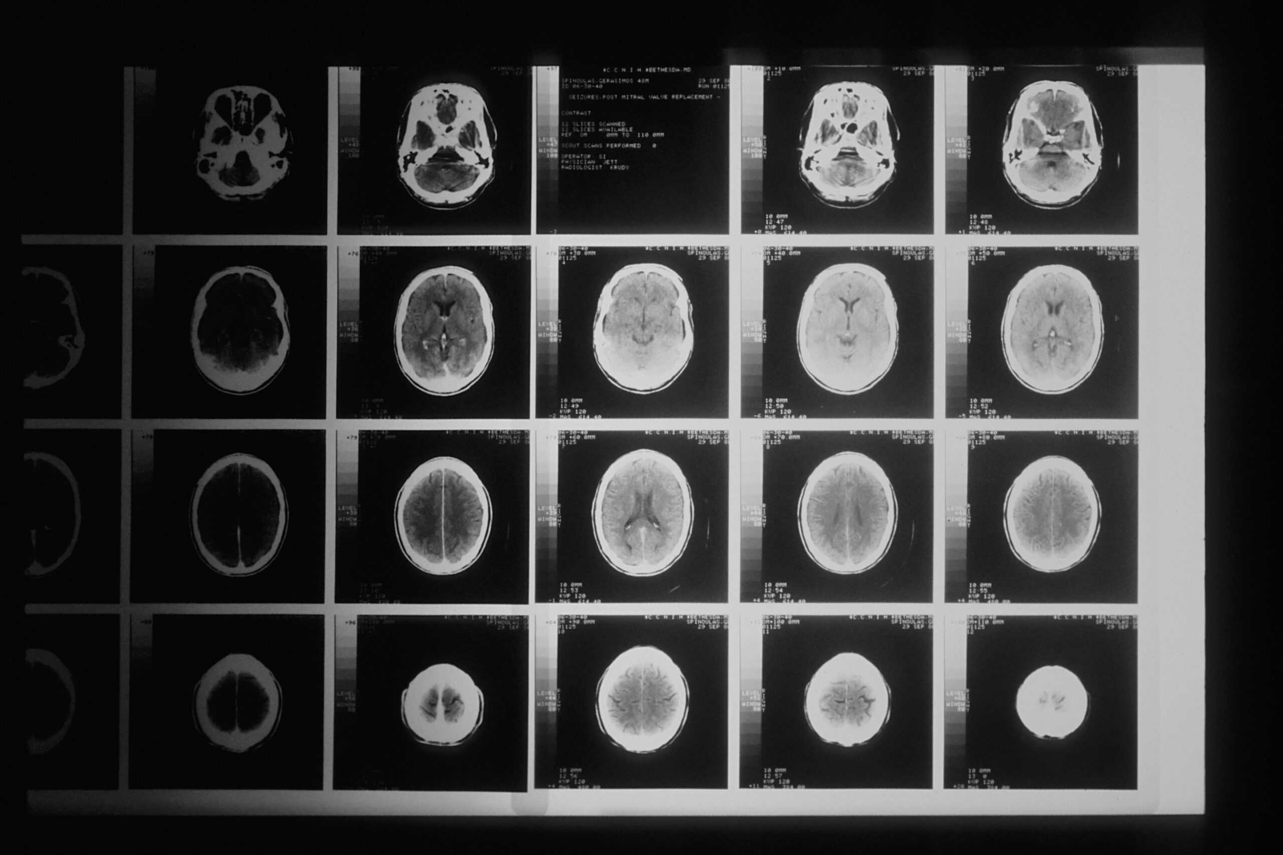OCD scan of the human brain